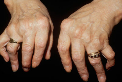 Arthritis Awareness How to Improve Quality of Life with Arthritis