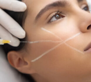 The Transformative Benefits of Sculptra for a Youthful Look