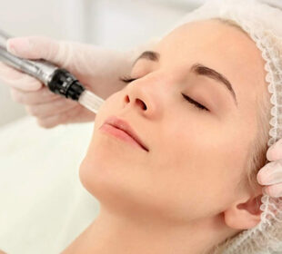 The Ultimate Guide to Microneedling Treatment in Suwanee, GA