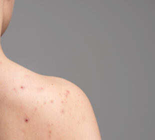 Why Do You Get Back Acne Common Causes and How to Tackle Them