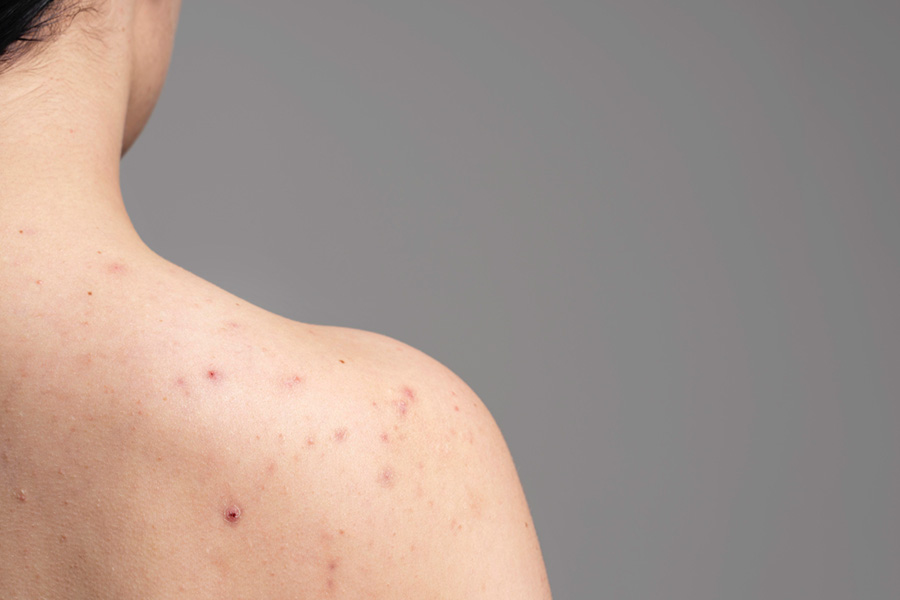 Why Do You Get Back Acne Common Causes and How to Tackle Them